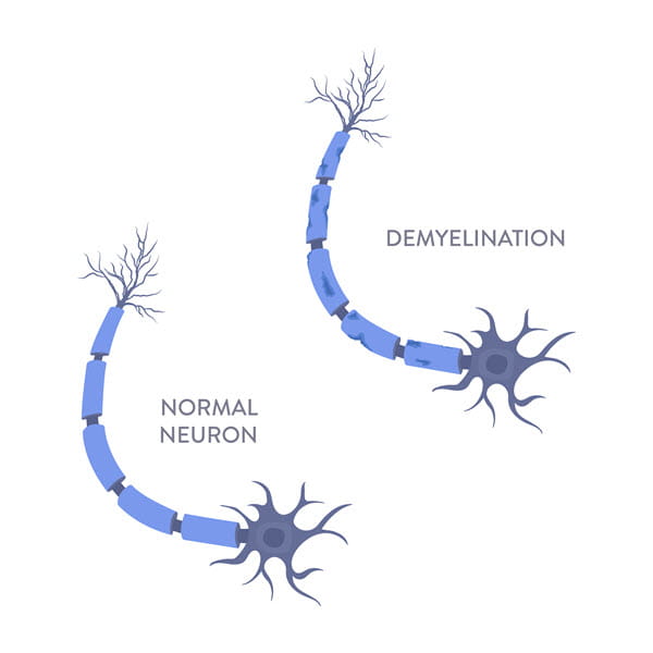 Multiple sclerosis graphic comparing normal nerve and one with myelin attack