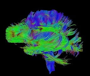 image of brain using BrightMatter technology as seen by Portland neurosurgeons
