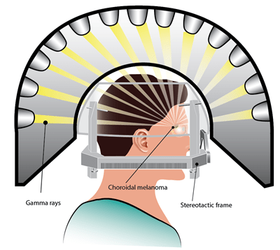 Gamma knife Stereotactic Radiosurgery | Eye Care | Legacy Health