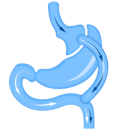 Gastric bypass stomach surgery diagram