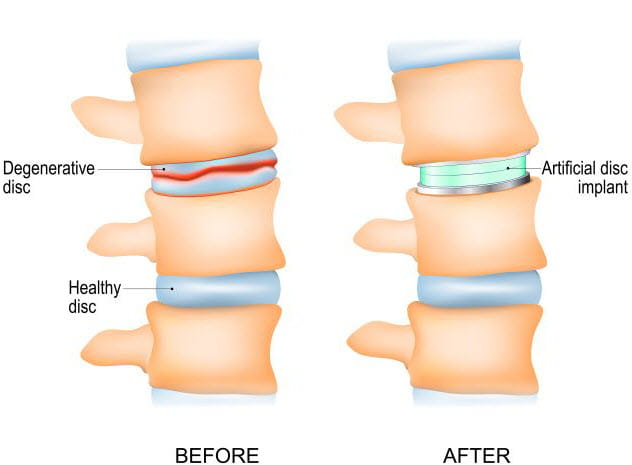 illustration showing an artificial disc implant 